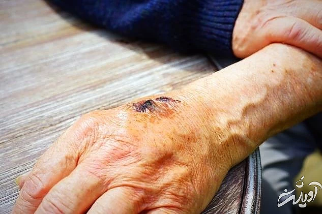 استفاده از نمک برای درمان زخم درمان زخم